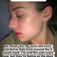 Dari tidak bisa menyentuh wajah tanpa terasa sakit hingga tidak ingin meninggalkan rumah karena takut aku kelihatan jelek, jerawatku telah mengambil alih hidupku. Setelah mencoba semuanya di pasar dan menerima komentar jahat mengenai keadaan kulitku, aku akhirnya memberanikan diri dan mulai minum Roaccutane, Foto: Instagram @ashleighwild_