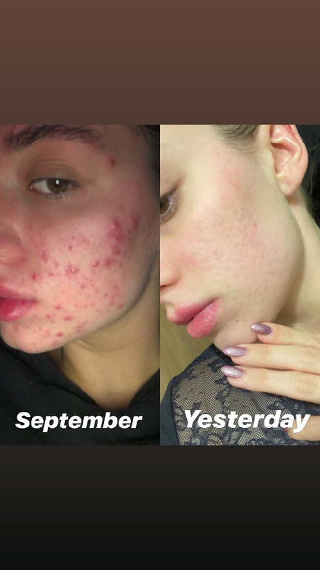 Beberapa waktu ini, Asleigh mulai sering mengunggah foto tanpa makeup yang menunjukkan perkembangan kondisi wajah. Bisa dilihat jika kini wajahnya jauh lebih baik. Foto: Instagram @ashleighwild_