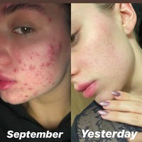 Beberapa waktu ini, Asleigh mulai sering mengunggah foto tanpa makeup yang menunjukkan perkembangan kondisi wajah. Bisa dilihat jika kini wajahnya jauh lebih baik. Foto: Instagram @ashleighwild_