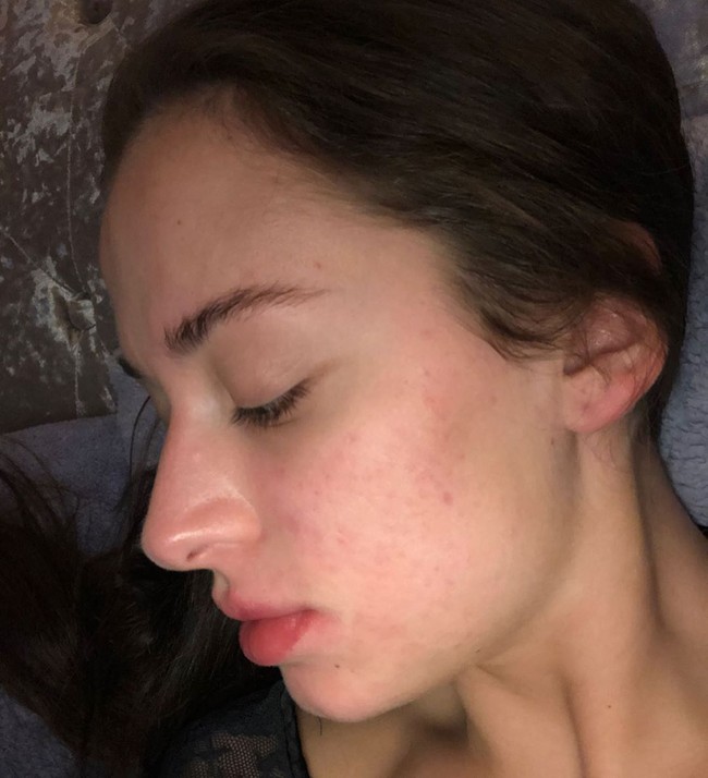 Di Instagram, Asleigh memang sering berbagi pengalamannya mengenai caranya menyembuhkan jerawat. Tak jarang ia memberikan tips dan nasehat untuk bisa tetap percaya diri dengan wajah jerawatan. Foto: Instagram @ashleighwild_