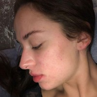 Di Instagram, Asleigh memang sering berbagi pengalamannya mengenai caranya menyembuhkan jerawat. Tak jarang ia memberikan tips dan nasehat untuk bisa tetap percaya diri dengan wajah jerawatan. Foto: Instagram @ashleighwild_