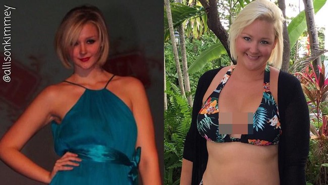 Sekarang Allison Kimmey memakai baju yang lebih besar lima ukuran dari sebelumnya. Meski begitu, Allison telah belajar menerima diri sendiri. Harapan bahwa foto transformasi terbalik ini bisa membuat satu orang menemukan kebahagiannya sekarang, tulisnya. Foto: Instagram @allisonkimmey. Foto: Instagram