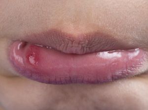 Viral Wanita Curhat Sering Sariawan, Ternyata Kena Kanker Mulut