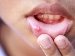 Anak Sariawan hingga Kesulitan Makan, Bagaimana Menyembuhkannya Dok?