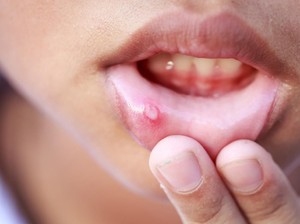 Sering Sariawan di Lidah-Gusi, Gimana Cara Mengatasinya Dok?