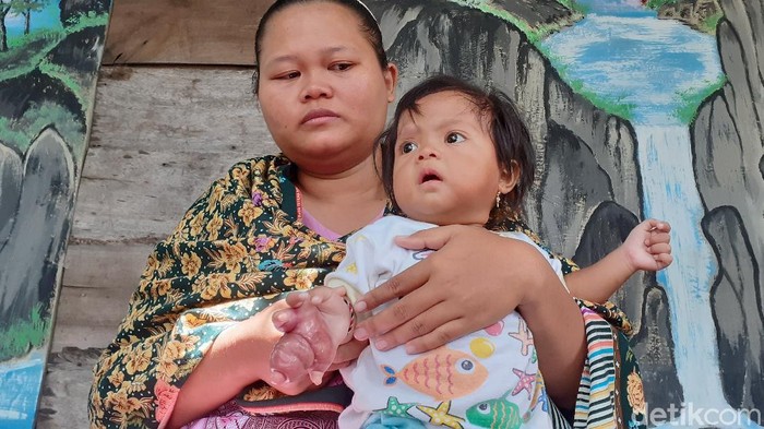 Pergelangan kanan Samara Kumaira Mariba, bayi berusia 11 bulan di Sragen terancam diamputasi, Jumat (6/3/2020).