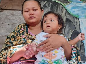 Sedih, Tangan Bayi 11 Bulan Asal Sragen Ini Terancam Diamputasi