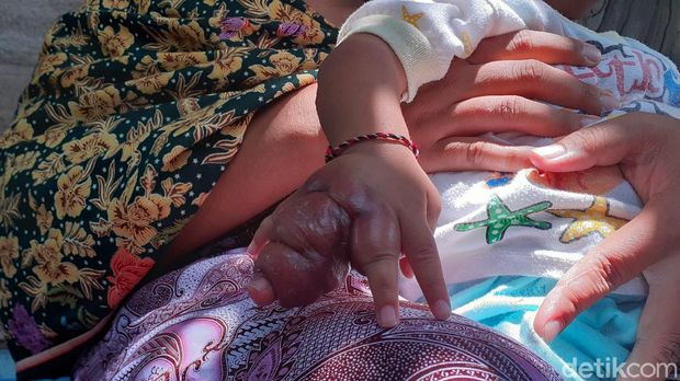 Sedih, Tangan Bayi Asal Sragen Ini Terancam Diamputasi