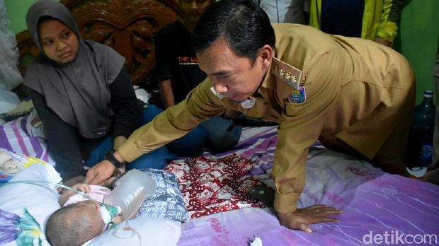 Menengok Bima, Bayi 6 Bulan yang Bernapas Bergantung Tabung Oksigen