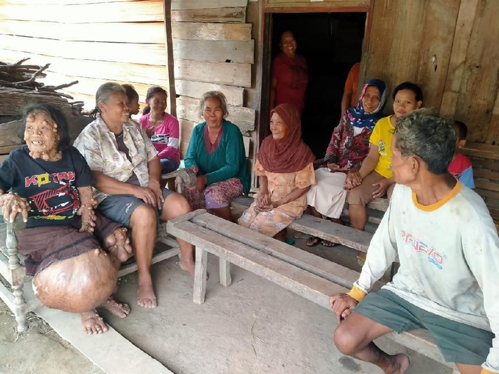 Lasiyem, pengidap tumor dan benjolan sekujur tubuh di Blora, Selasa (10/3/2020).