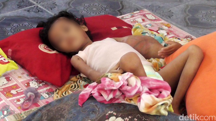 Balita Penderita Tumor Ganas Ini Butuh Bantuan Malang nasib Nurhanifa, gadis cilik berusia 4 tahun 10 bulan, bungsu dari dua bersaudara pasangan Tamsil dan Jamila. Sudah tiga tahun lamanya, gadis cilik asal Dusun Kebun Dalam, Desa Bumiayu, Kecamatan Wonomulyo, Kabupaten Polewali Mandar, hidup dalam kondisi memprihatinkan, lantaran menderita tumor ganas.