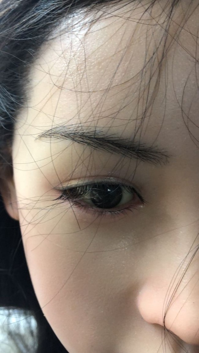 Rambut tidak hanya diimplan di kepala, namun juga di alis dan bulu mata. Foto: dok. Sillicon Lovers