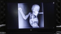 DNA orangutan 97% sama dengan manusia. Ini adalah foto rontgen anak orang utan , mirip sekali dengan manusia bukan? (Getty Images)