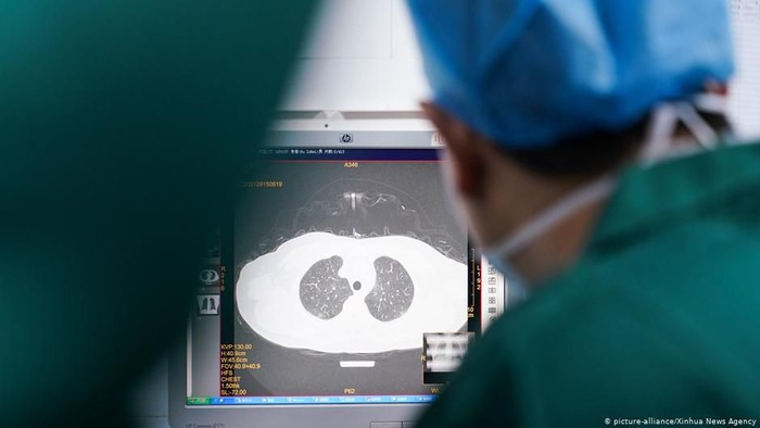 Jalani Transplantasi, Ini Potret Kerusakan Paru-paru Wanita karena Corona