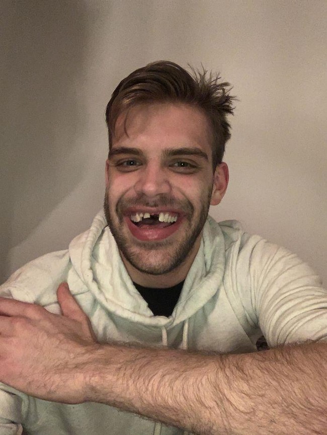 Pria ini harus hidup dengan kondisi giginya seperti di foto berikut ini. Covid-19 Shut Down The Dental School I Was Getting Work Done On For The Next Month. Wish Me Luck, tulisnya pada keterangan foto yang diunggahnya ke Reddit. Kata si pria virus corona membuat sekolah kedokteran tempat dia menjalani perawatan gigi harus ditutup. Dia pun harus hidup dengan kondisi gigi tersebut setidaknya selama sebulan ke depan. (Foto: Dok. Bored Panda)