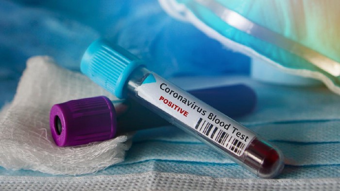 Positive blood test result for the new rapidly spreading Coronavirus, originating in Wuhan, China