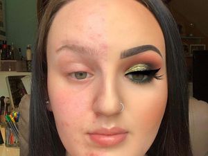 Hanya Pakai 3 Produk, Wajah Berjerawat Wanita Ini Jadi Super Flawless