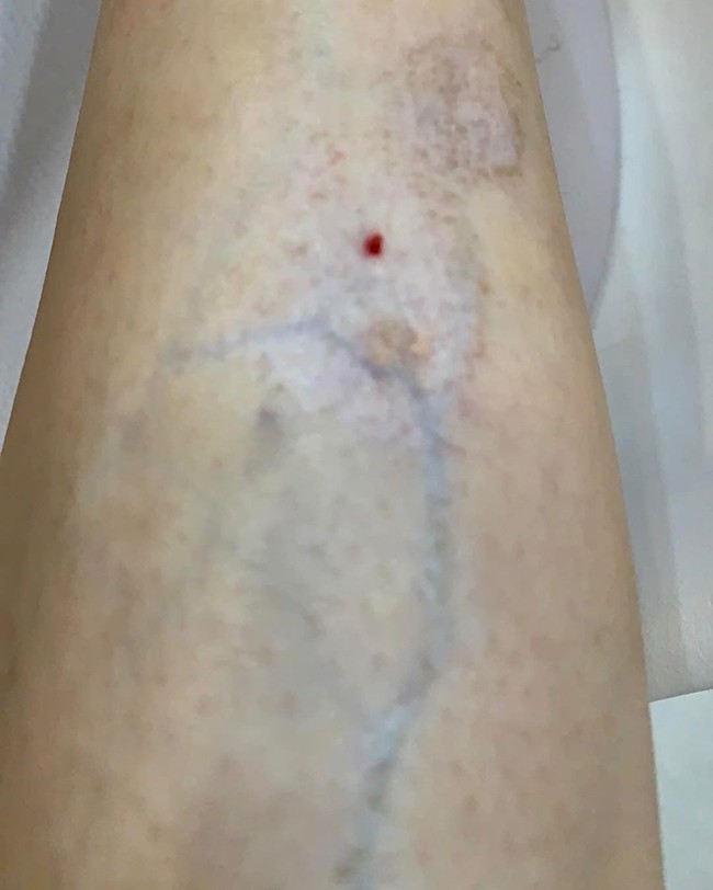 Tak lama setelahnya Mai mulai mendapati rasa tidak nyaman di bagian yang di-filler seperti digigit semut selama seminggu. Ketika ditanyakan pada pemilik klinik, ia mengatakan hal tersebut normal dan akan hilang dengan sendirinya. Foto: Instagram @suongsyn