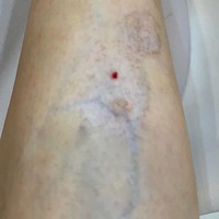 Tak lama setelahnya Mai mulai mendapati rasa tidak nyaman di bagian yang di-filler seperti digigit semut selama seminggu. Ketika ditanyakan pada pemilik klinik, ia mengatakan hal tersebut normal dan akan hilang dengan sendirinya. Foto: Instagram @suongsyn