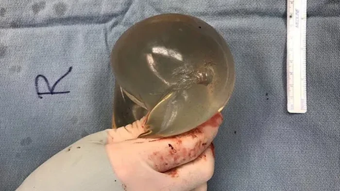 Kata Ahli Pemakaman soal Nasib Implan Payudara pada Jenazah