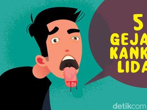 5 Gejala Kanker Lidah, Mati Rasa hingga Sariawan Tak Sembuh-sembuh