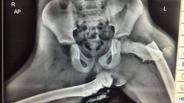 X-Ray kecelakaan kaki di atas dashboard mobil