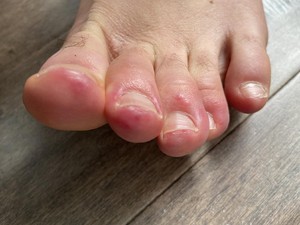 Fenomena Covid Toes, Muncul Ruam pada Jari Kaki Pasien Positif Corona