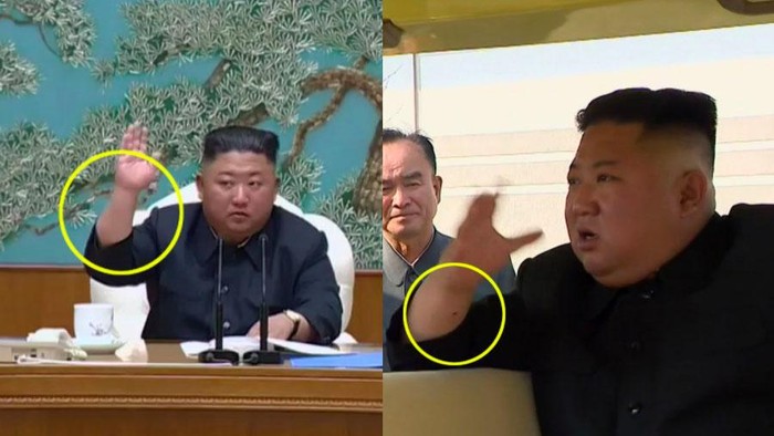 kim jong un bekas operasi kim jong un bekas operasi
