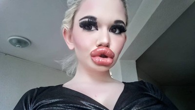 Foto Before-After Wanita Obsesi Punya Bibir Terbesar di Dunia, Dulu Lebih Cantik