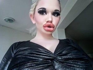 Wanita dengan Bibir Terbesar di Dunia Kecanduan Filler, Ini Penampilannya Dulu