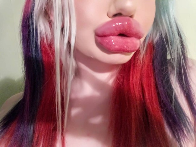 Andrea mengaku telah melakukan suntik hyaluronic acid sebanyak 20 kali di bibirnya. Beginilah keadaan bibir wanita 22 tahun itu.  Foto: dok. Instagram