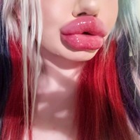 Andrea mengaku telah melakukan suntik hyaluronic acid sebanyak 20 kali di bibirnya. Beginilah keadaan bibir wanita 22 tahun itu.  Foto: dok. Instagram