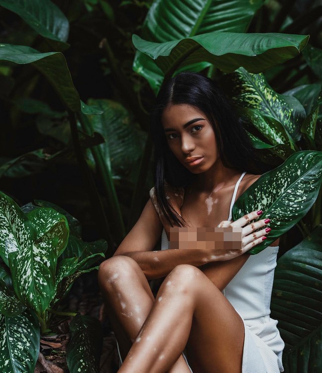 Kenalan dengan Paulett Rosales, model asal Panama yang menderita vitiligo atau kelainan warna kulit di bagian tangan dan leher. Foto: Instagram