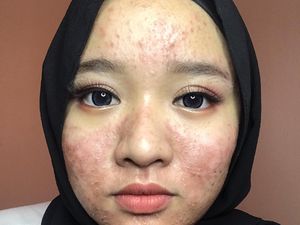 Wanita Ini Percaya Diri Tampil Berjerawat Parah di Media Sosial