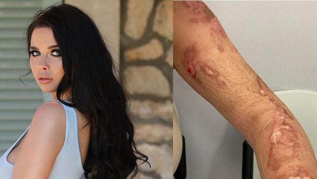 Kym Graham, model yang kulitnya rusak karena produk tanning meledak.