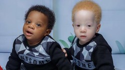 Bayi kembar asal Lagos ini terlahir dengan perbedaan yang cukup mengejutkan, salah satu diantaranya memiliki Albinisme sehingga memiliki warna kulit putih pucat