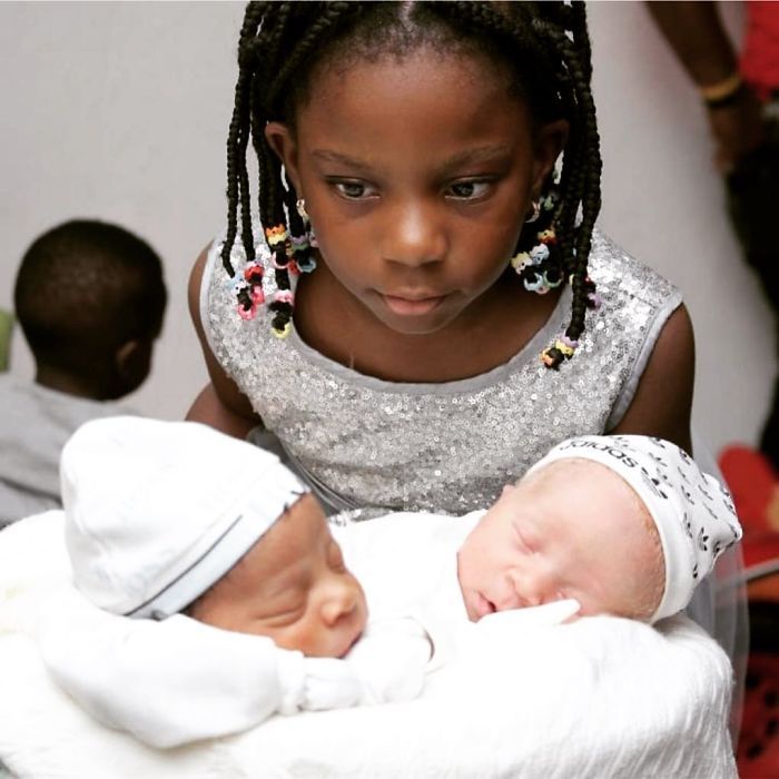 Bayi kembar asal Lagos ini terlahir dengan perbedaan yang cukup mengejutkan, salah satu diantaranya memiliki Albinisme sehingga memiliki warna kulit putih pucat.