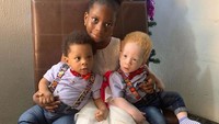 Tingkat orang yang hidup dengan albinisme di Nigeria adalah salah satu yang tertinggi di dunia dengan perkiraan jumlah lebih dari dua juta albino yang tinggal di negara itu. Istimewa/Dok. Boredpanda/danielanddavid2.