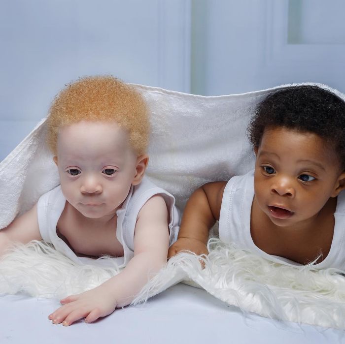 Bayi kembar asal Lagos ini terlahir dengan perbedaan yang cukup mengejutkan, salah satu diantaranya memiliki Albinisme sehingga memiliki warna kulit putih pucat.