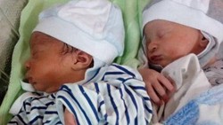 Bayi kembar asal Lagos ini terlahir dengan perbedaan yang cukup mengejutkan, salah satu diantaranya memiliki Albinisme sehingga memiliki warna kulit putih pucat
