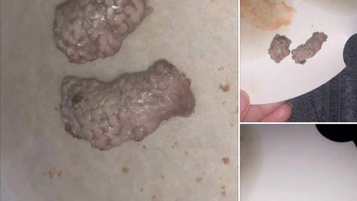 Temukan Otak di Menu KFC, Wanita Ini Trauma hingga Mau Jadi Vegetarian