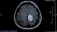 Tumor Otak pada Anak Bukan Berarti Vonis Mati