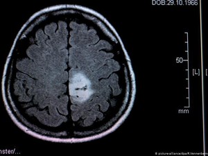 Tumor Otak pada Anak Bukan Berarti Vonis Mati
