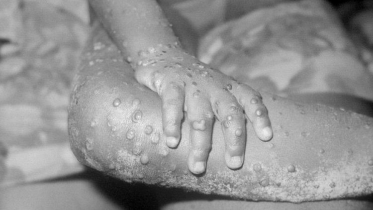 Covid-19: Cacar, penyakit yang diberantas dalam waktu 200 tahun, satu-satunya yang berhasil dibasmi dalam sejarah manusia, apa yang bisa dipelajari dalam hadapi wabah virus corona Covid-19: Cacar, penyakit yang diberantas dalam waktu 200 tahun, satu-satunya yang berhasil dibasmi dalam sejarah manusia, apa yang bisa dipelajari dalam hadapi wabah virus corona