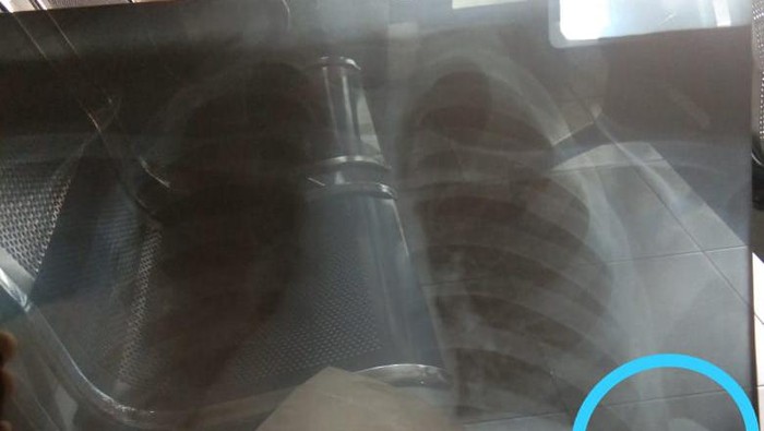Bocah korban peluru nyasar di Pademangan