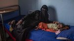 Potret Anak-anak Yaman yang Terancam Kelaparan