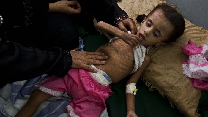Potret Anak-anak Yaman yang Terancam Kelaparan AL KHAWKHAH, YEMEN - SEPTEMBER 18: Fatima Ali sits with her daughter, Namih, who is undergoing treatment for severe acute malnutrition at a health clinic on September 18, 2018 in Al Khawkhah, Yemen. Ali and her daughter fled fighting in Haiz, a frontline in Hodeidah province, and have been displaced from their home for nine months. A coalition military campaign has moved west along Yemen's coast toward Hodeidah, where increasingly bloody battles have killed hundreds since June, putting the country's fragile food supply at risk. (Photo by Andrew Renneisen/Getty Images)