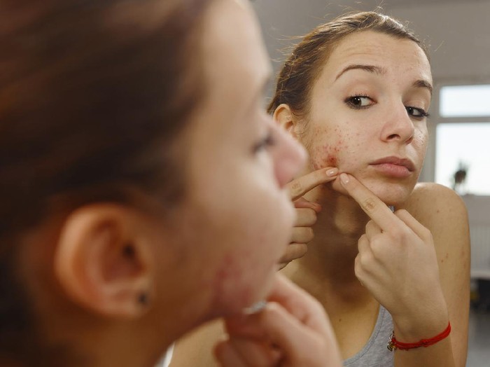 jerawat teenager portrait with acne looking in the mirror.