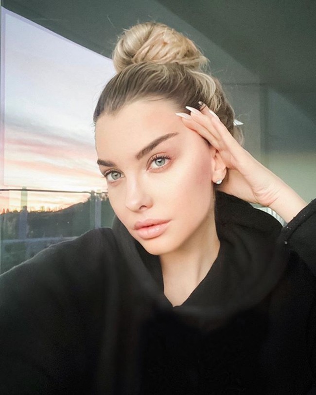 Pembedahan craniotomy berisiko membuat Emily Sears kehilangan kemampuannya berbicara. Untuk mencegah hal tersebut terjadi, Emily harus dioperasi dalam keadaan sadar, atau hanya dibius lokal. Foto: Instagram/@emilysears