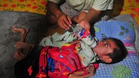 Indonesia memang sudah menghadapi masalah gizi yang tinggi bahkan sebelum adanya COVID-19. Hingga saat ini, lebih dari dua juta anak menderita gizi buruk dan lebih dari tujuh juta anak di bawah 5 tahun mengalami stunting. ANTARA FOTO/Wahdi Septiawan  